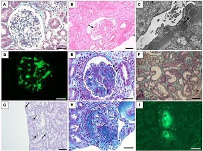 Kidney injury associated with COVID-19 infection and vaccine: A narrative review